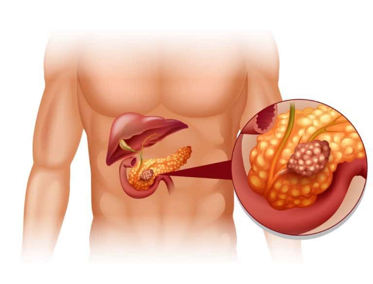 High blood sugar increases pancreatic cancer rate
