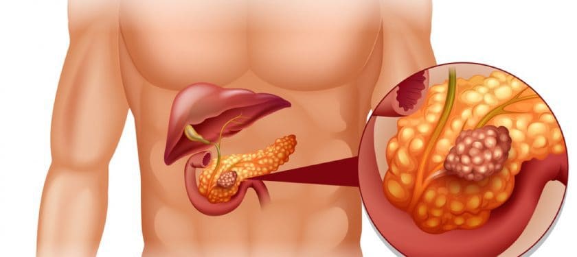 Depositphotos_84327566_m-2015-blueringmedia-1250 pancreatic cancer