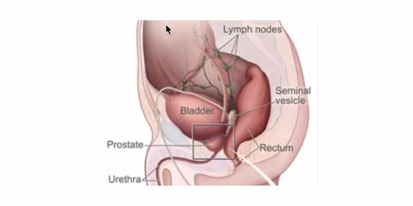 Study identifies a genetic driver of deadly prostate cancer