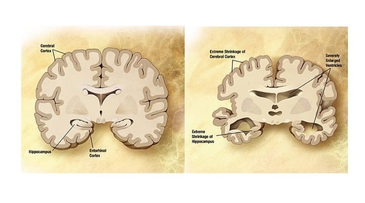640px-Alzheimer's_disease_brain_comparison 640px-Alzheimer's_disease_brain_comparison