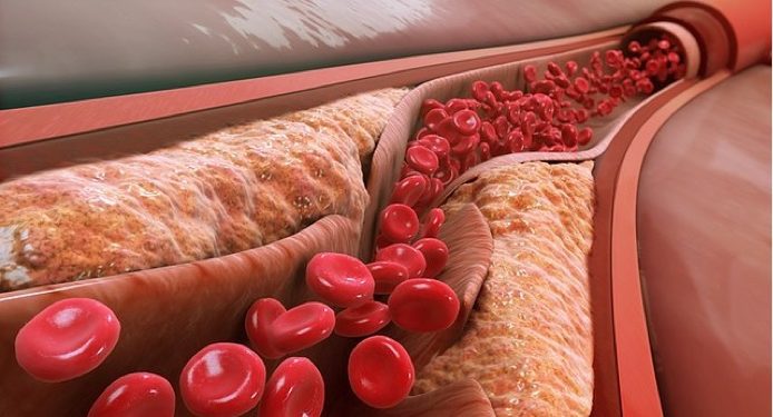 640px-Atheroma atherosclerosis