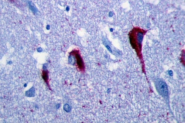640px-Neurofibrillary_tangles_in_the_Hippocampus_of_an_old_person_with_Alzheimer-related_pathology,_immunohistochemistry_for_tau_protein tau tangles