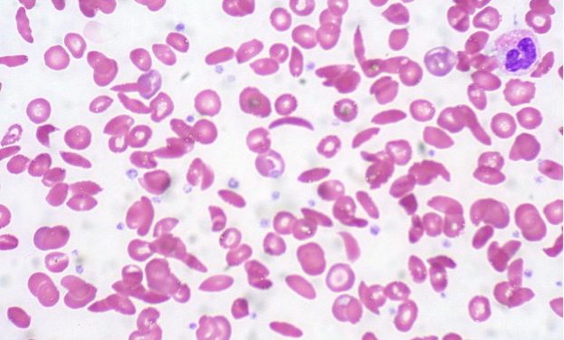 640px-Sickle_Cell_Anemia_(5610746554) 640px-Sickle_Cell_Anemia_(5610746554)