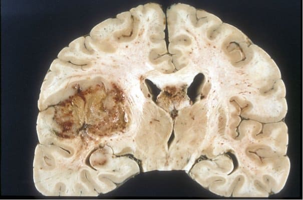 New immunotherapy target discovered for malignant brain tumors