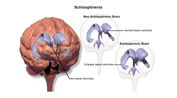 640px-Schizophrenia_(Illustration) 640px-Schizophrenia_(Illustration)