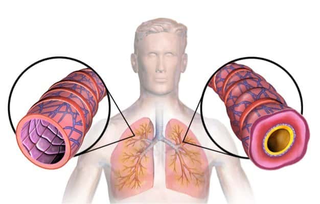 Asthma_(Lungs) Asthma_(Lungs)
