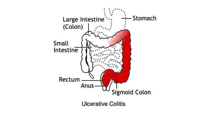 Scientists connect dots between colitis and colon cancer