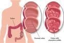 Chronic inflammation alters the evolution of cells in the colon