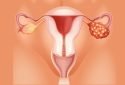 Researchers identify protein governing platinum resistant ovarian cancer