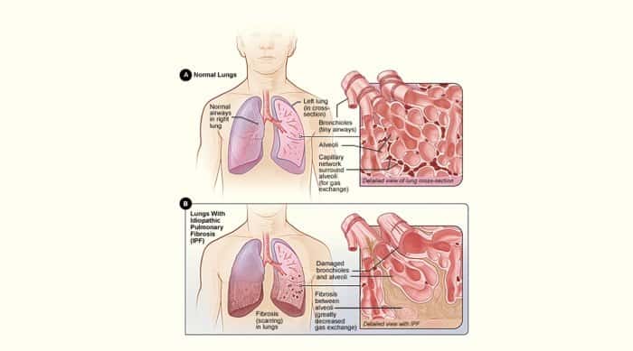 Ipf_NIH Ipf_NIH