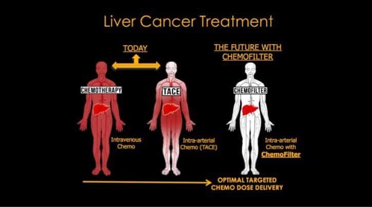 Liver cancer treatment - Anand Patel, MD, UCSF Liver cancer treatment - Anand Patel, MD, UCSF