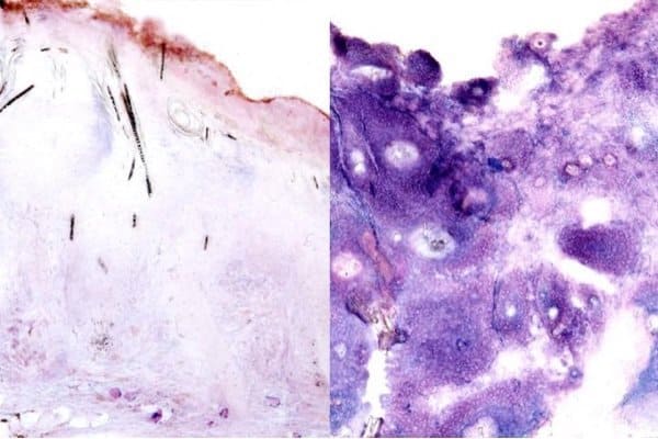 Tumor comparison - UCLA Broad Stem Cell Research Center - Nature Communications Tumor comparison - UCLA Broad Stem Cell Research Center - Nature Communications