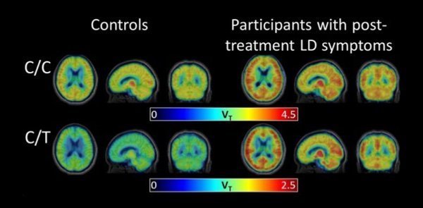 New scan technique reveals brain inflammation associated with post-treatment Lyme disease syndrome