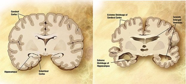 A new culprit of cognitive decline in Alzheimer’s disease