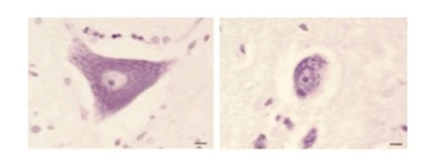 ALS_loss_of_neurons-1-1 ALS