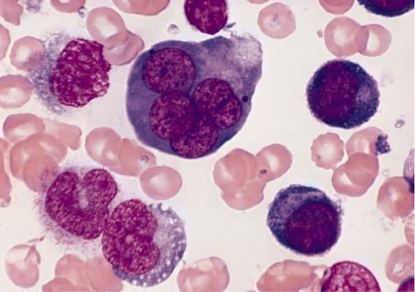 640px-AML-M6,_multinucleated_erythroblast 640px-AML-M6,_multinucleated_erythroblast