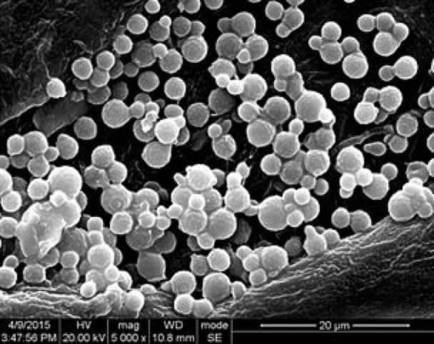 640px-Pityrosporum_folliculitis_2 640px-Pityrosporum_folliculitis_2