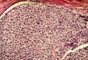 Free fatty acids rewire cells to promote obesity-related breast cancer