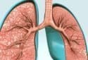 Three-drug combo improves lung function in most common genetic form of cystic fibrosis