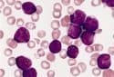 Probing the mystery of drug resistance: New hope for leukemia's toughest cases