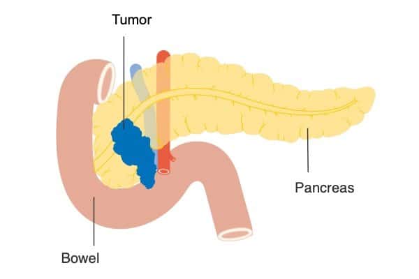 Bringing the ‘sticky’ back to pancreatic cancer
