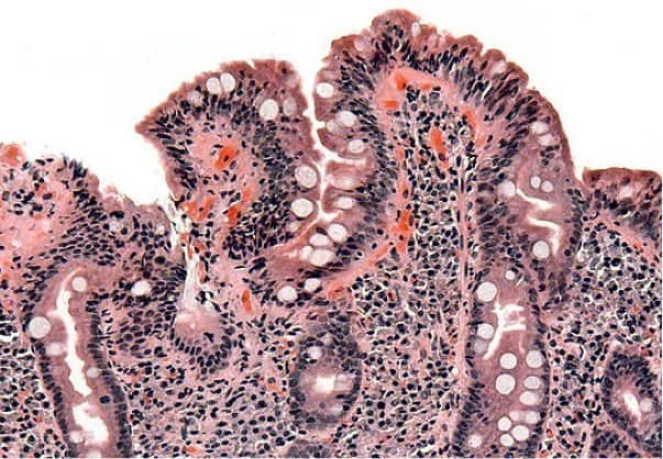 542px-Coeliac_path 542px-Coeliac_path