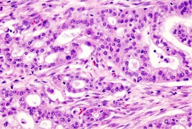 638px-Pancreas_adenocarcinoma_(4)_Case_01 638px-Pancreas_adenocarcinoma_(4)_Case_01