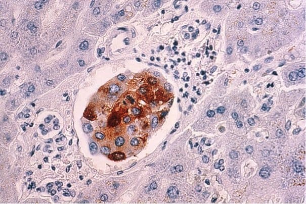 640px-Breast_cancer_metastasis_to_liver 640px-Breast_cancer_metastasis_to_liver