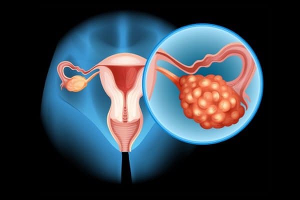 Drug prolongs life of ovarian cancer patients