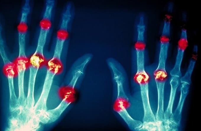 New clues on tissue damage identified in rheumatoid arthritis and lupus