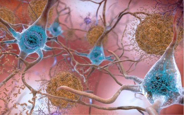 Neurons, amyloid plaques