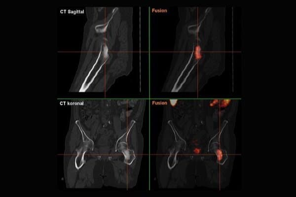 480px-OsteoplasticMetastasisProstateCancer 480px-OsteoplasticMetastasisProstateCancer