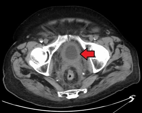bladder cancer CT scan