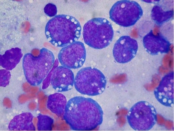 640px-Burkitt_lymphoma,_touch_prep,_Wright_stain Burkitt lymphoma