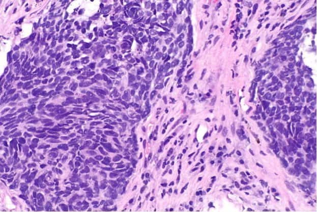 640px-Non-small_cell_lung_carcinoma_--_high_mag 640px-Non-small_cell_lung_carcinoma_--_high_mag