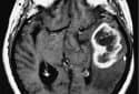 Scientists ID gene responsible for deadly glioblastoma