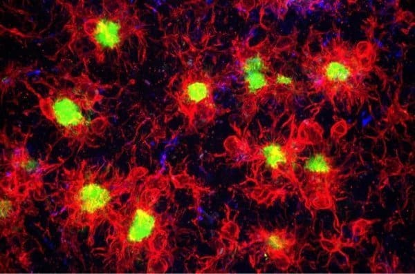 Scientists discover gene signature for amyloid plaque-eating microglia in Alzheimer’s disease