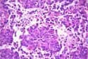 Metabolic inhibitor extends survival in mice with certain pediatric brain tumors