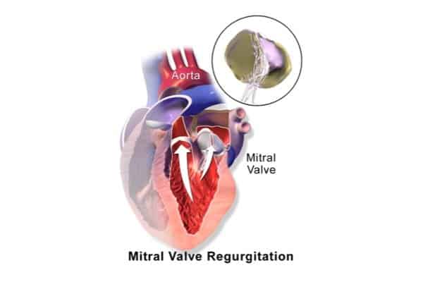 Mitral_Valve_Regurgitation Mitral regurgitation