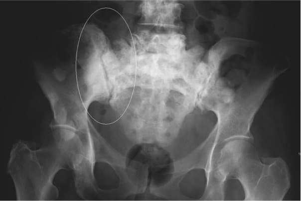 543px-ScleroticMetsB 543px-ScleroticMetsB