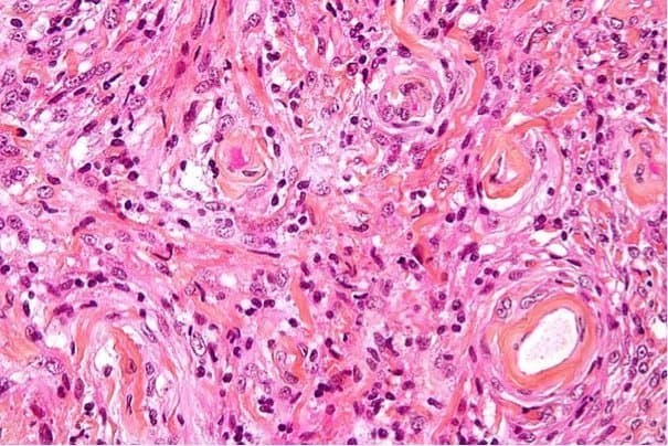 640px-Meningioma_high_mag 640px-Meningioma_high_mag