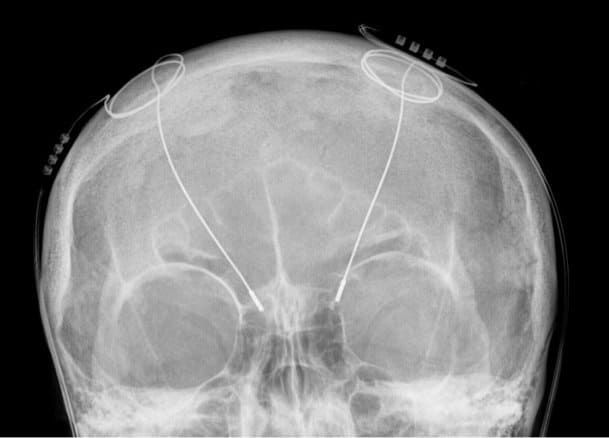Tiefe_Hirnstimulation_-_Sonden_RoeSchaedel_ap deep brain stimulation