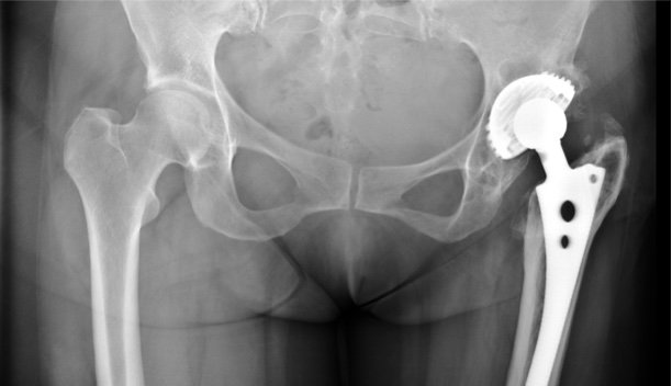Depositphotos_8253471_s-2019-itsmejust-crop hip fracture, hip replacement