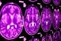 Brain imaging predicts PTSD after brain injury
