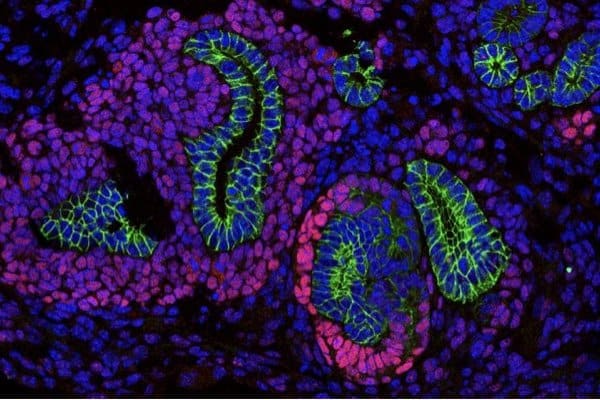 Scientists discover a new mechanism in childhood kidney cancer