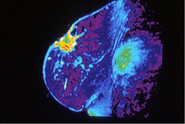 HER2-targeting antibody-drug improves progression-free survival for women with deadly form of metastatic breast cancer
