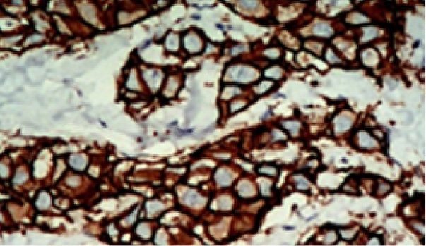 586px-Positive_immunohistochemistry_of_HER2_in_invasive_breast_cancer 586px-Positive_immunohistochemistry_of_HER2_in_invasive_breast_cancer