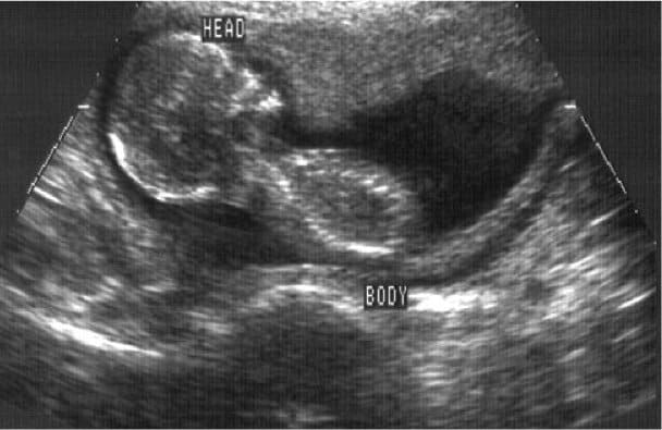 Ultrasound_lores Human fetus ultrasound