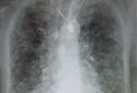 Inhalation therapy shows promise against pulmonary fibrosis in preclinical studies