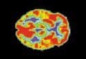 Study detects abnormally low levels of a key protein in brains of young men with autism